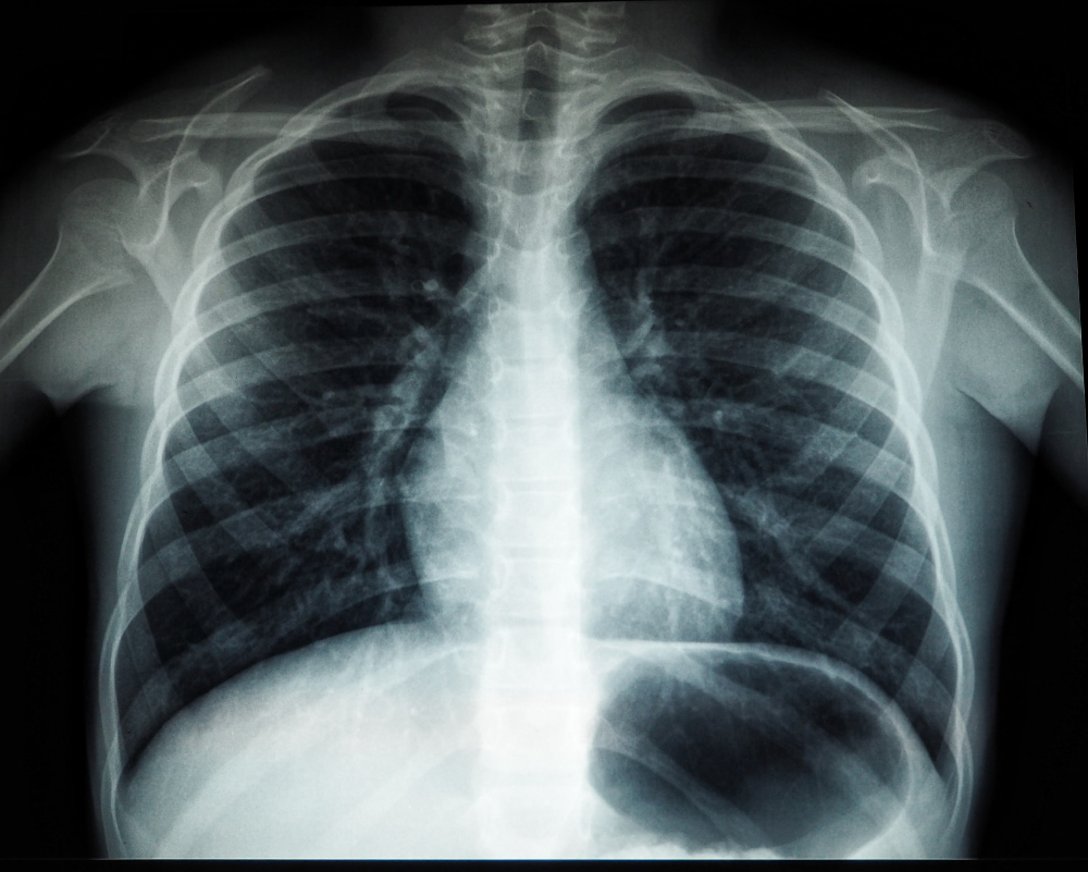 la fibrose pulmonaire